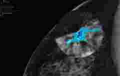 A diagnostic image showing breast density through DL Precise on a breast imaging display