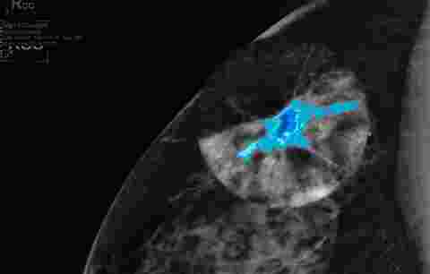 A diagnostic image showing breast density through DL Precise on a breast imaging display